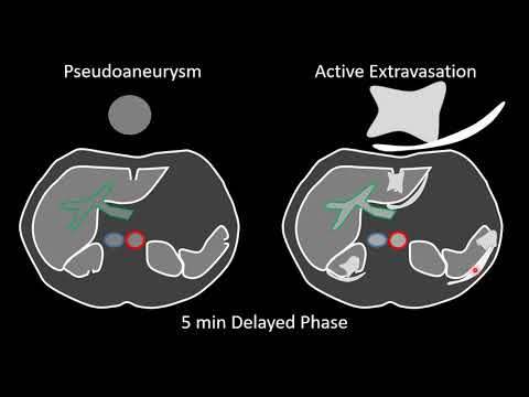 Video: Inkstų Ir Uro Trauma: WSES-AAST Rekomendacijos