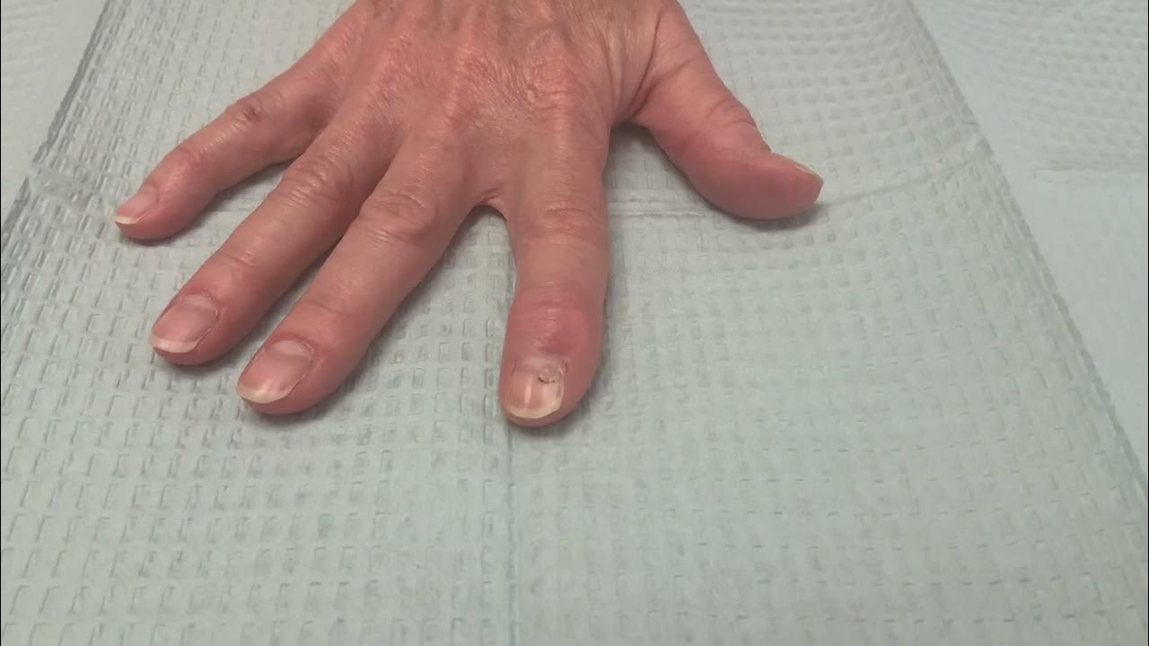 Right index finger mucous cyst excision with local advancement flap