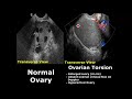 Ovary ultrasound normal vs abnormal image appearances  ovarian pathologies on usg