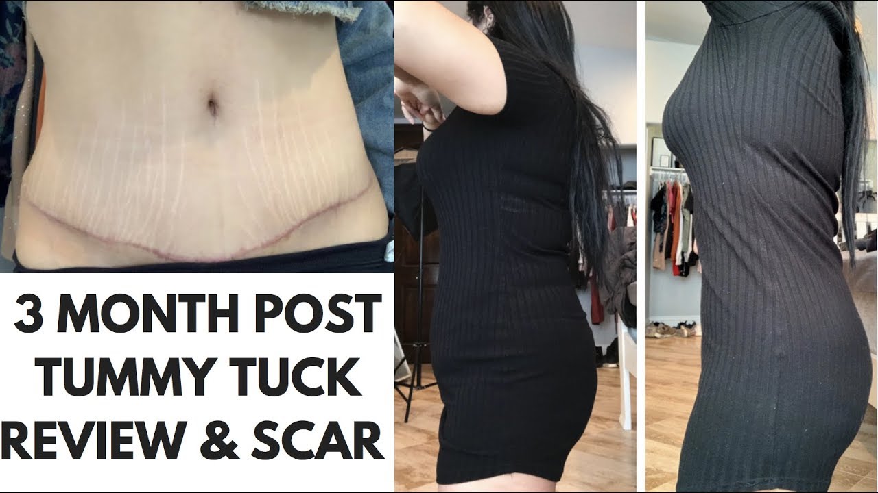 TUMMY TUCK SCAR AND BEFORE AND AFTER PICTURES // PLASTIC SURGERY