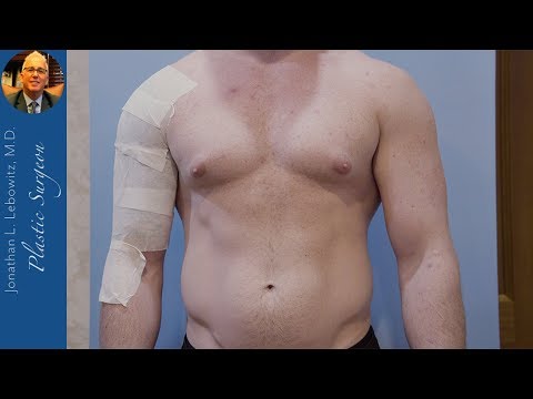 Videó: Mellnagyobbítás Férfiakban (Gynecomastia)