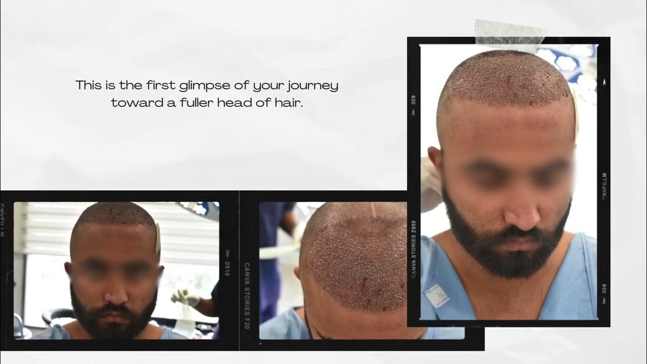 Hair Transplant Journey Incredible Before & After Transformation 🌟💇♂️