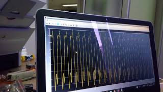 Optimization of Exoskeleton Motorized Wheelchair through Matlab Simulation