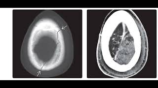 Brain trauma radiology