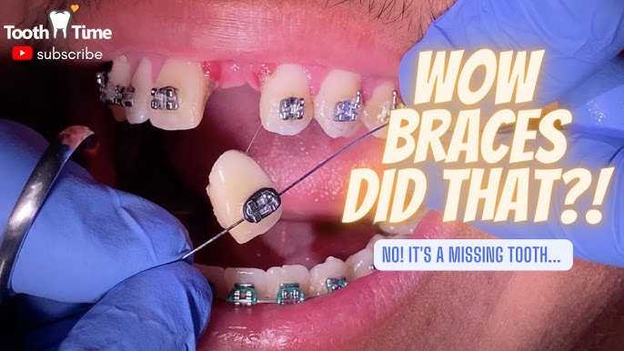 My Last Braces Checkup - Bending orthodontic wire - Tooth Time Family  Dentistry New Braunfels 