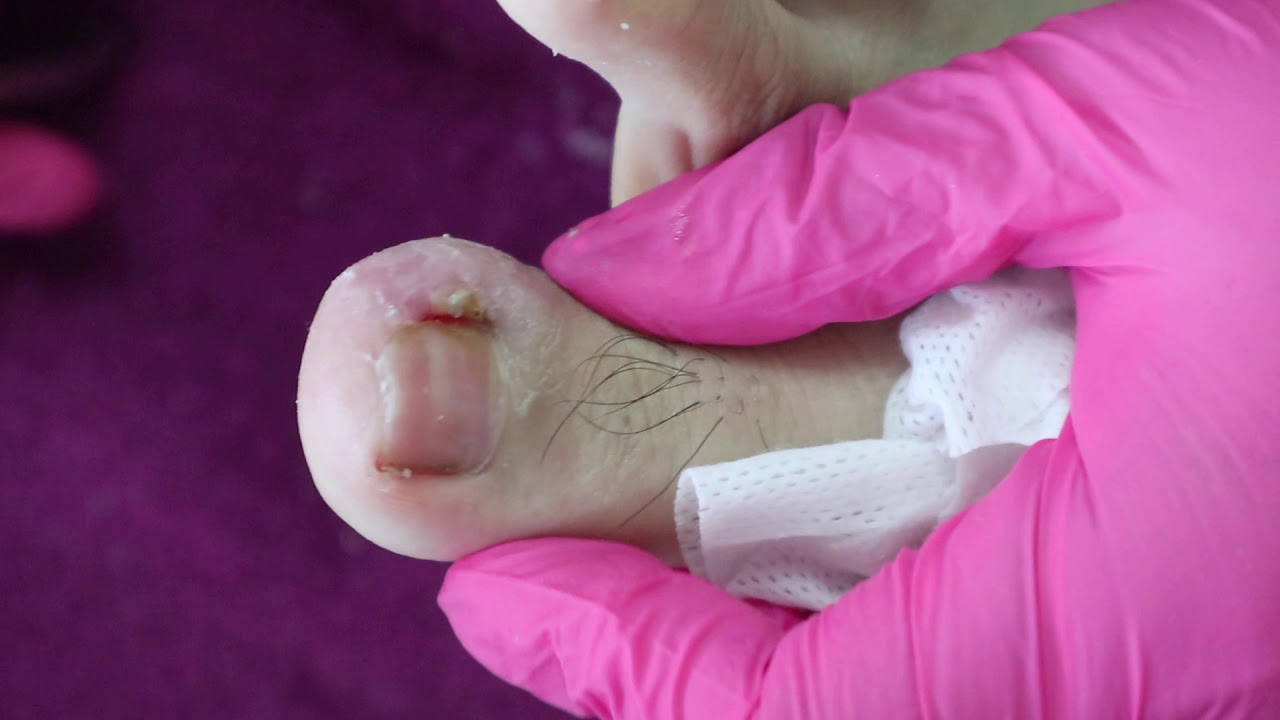 Ep_953 Ingrown toenail removal ������ ตัดออกไม่หมด..เหลือตรงกลางเจ็บมากก ������ (This clip from Thailand