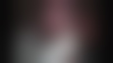 Robot Cholecystectomy Using ICG (Firefly) Imaging