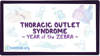 Thoracic outlet syndrome (Year of the Zebra)