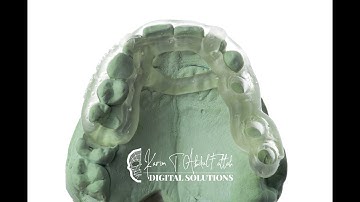 Designing your 1st Implant guide using B4D and 3D Slicer (Simplified)