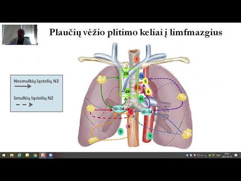 Video: Stambiųjų Ląstelių Plaučių Vėžys: Simptomai Ir Prognozė. Kaip Gydyti Stambiųjų Ląstelių Plaučių Vėžį