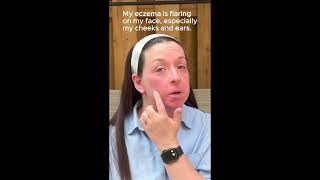 Chava shares her eczema flares on her face | Eczema Awareness Month #UnhideEczema