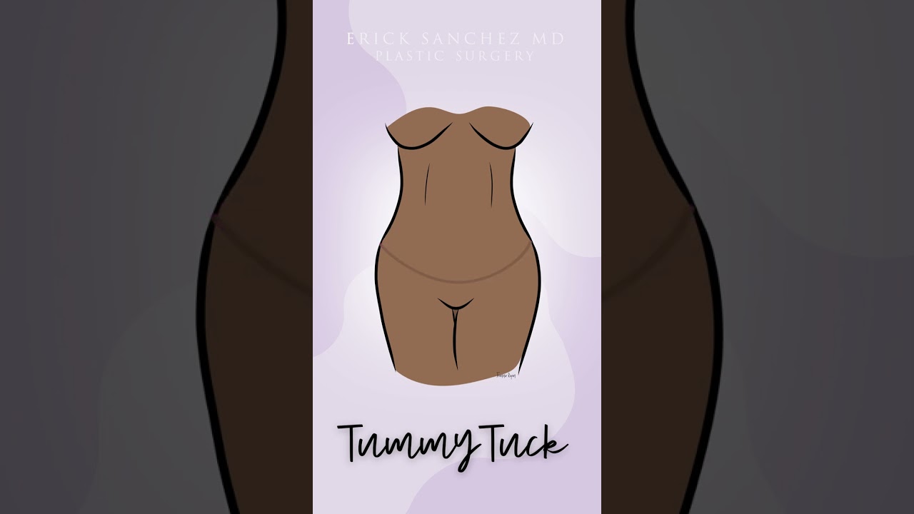 ⁣Animation of Tummy Tuck aka Standard Abdominoplasty