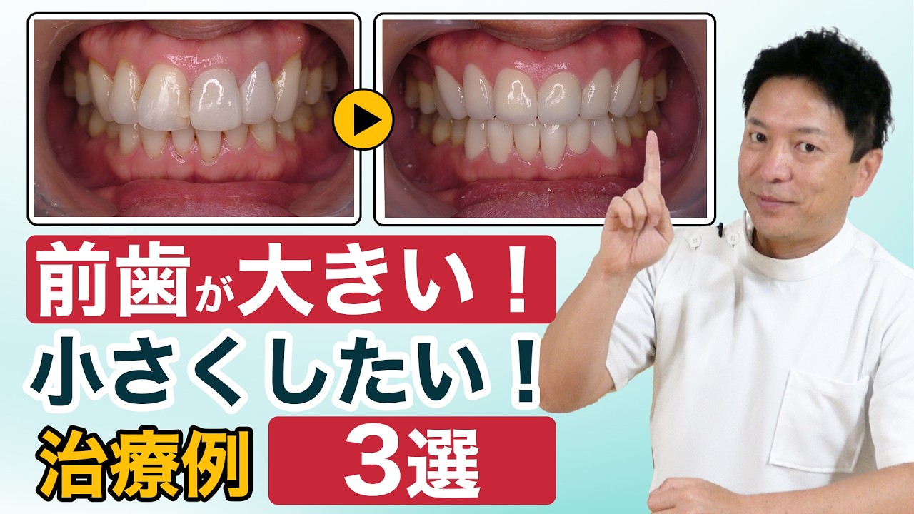 Want Smaller Front Teeth? 3 Case Studies Using Gentle Treatment
