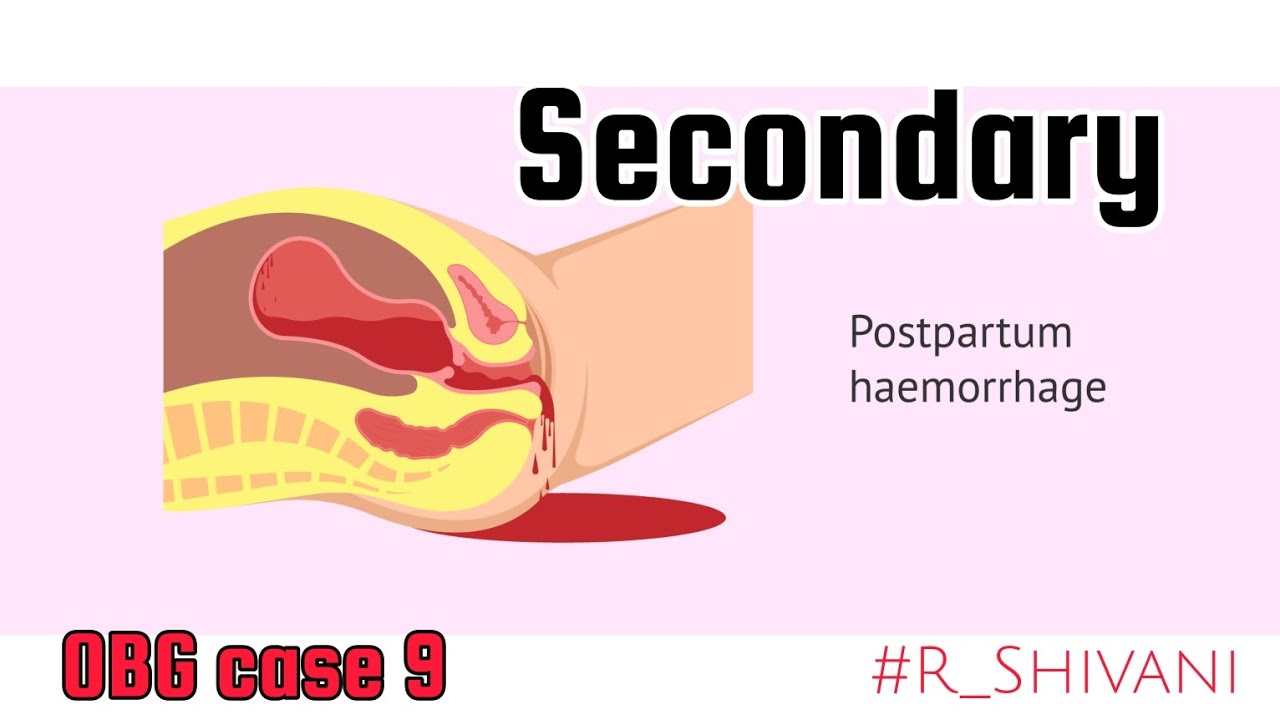 Secondary postpartum haemorrhage | #OBG |case study 9 | #R_Shivani #PharmD #PPH