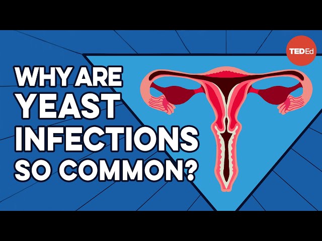What causes yeast infections, and how do you get rid of them? - Liesbeth Demuyser class=