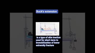 #bucks #traction #short #bone #alignment #immobilzation #dailyshorts #nursing #paramedical #medico