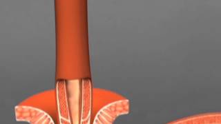Linx Surgery for Reflux Disease