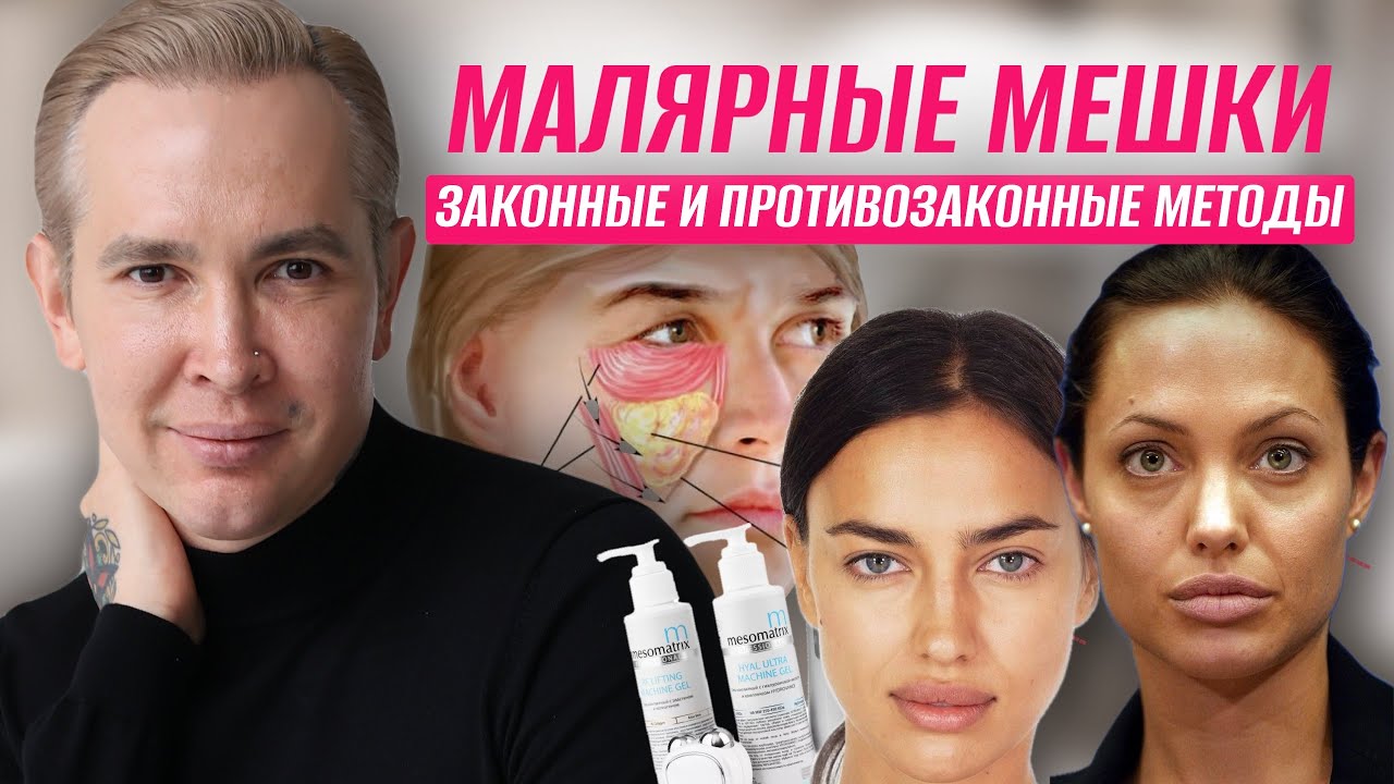Малярные мешки ЗАКОННЫЕ И ПРОТИВОЗАКОННЫЕ методы удаления Реальное избавление от мешков под глазами
