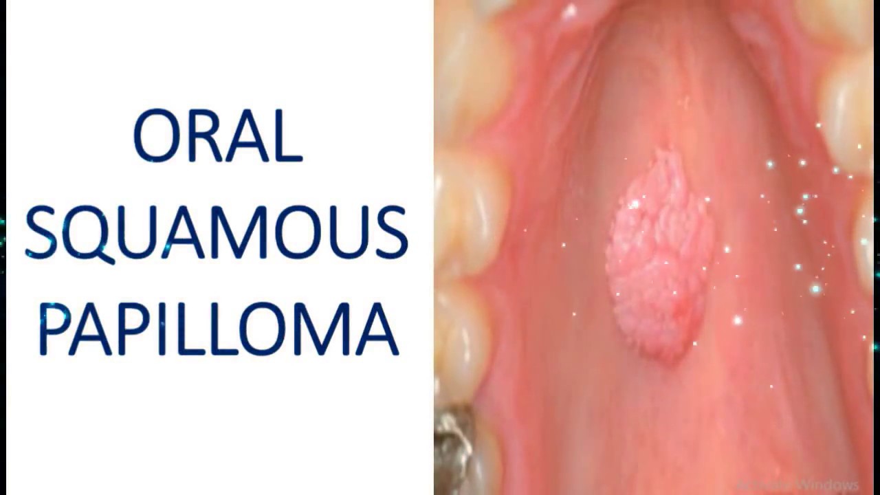 Squamous papilloma tip of tongue