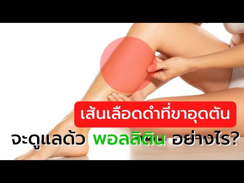 เส้นเลือดดำที่ขาอุดตัน จะดูแลด้วยพอลลิติน อย่างไร