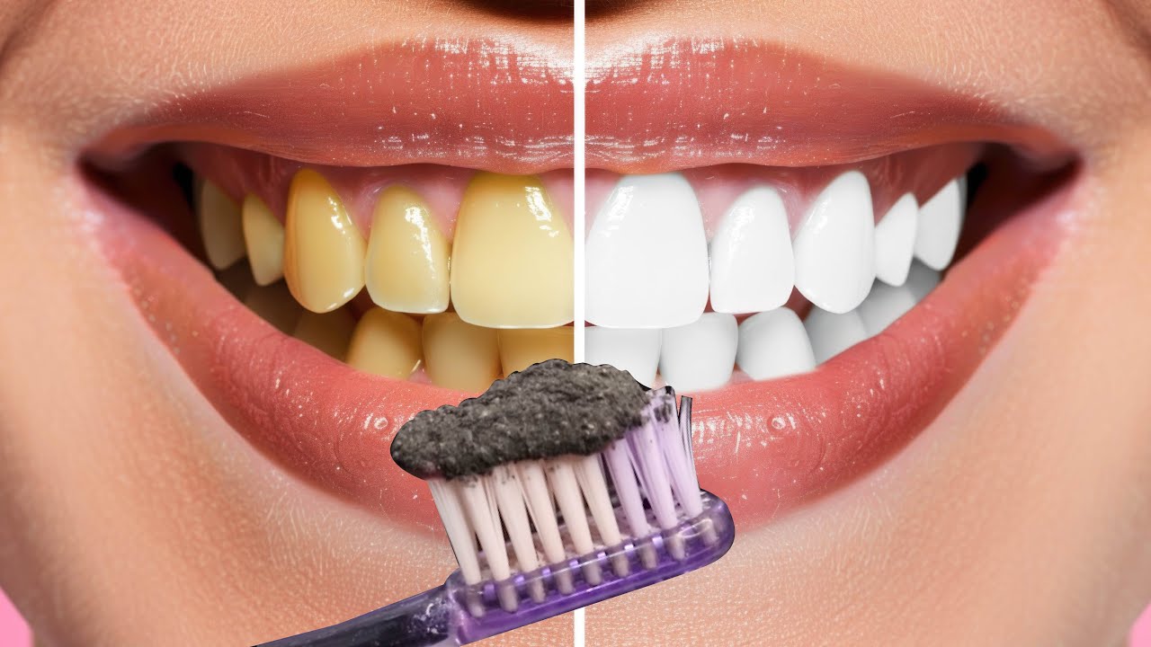 Teeth whitening at home in 2 minutes naturally | Remove Tartar and ...