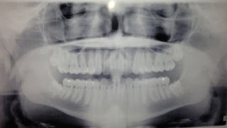 Wisdom Teeth Pulling: 2013
Recently, I had my wisdom teeth pulled before school starts up again.
We decided to record my reactions.
Everything you see here is unscripted, and all natural reactions.
More videos to be coming soon :)
I hope you all enjoyed, and have a great day! Wisdom Teeth Pulling: 2013