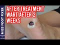 AFTER TREATMENT VIDEO WART AFTER 2 WEEKS! FULL TREATMENT BY MISS FOOT FIXER