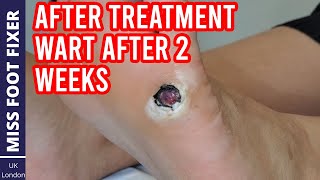 AFTER TREATMENT VIDEO WART AFTER 2 WEEKS! FULL TREATMENT BY MISS FOOT FIXER