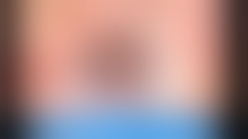 Fuchs endothelial dystrophy Lukan Mishev Live Stream