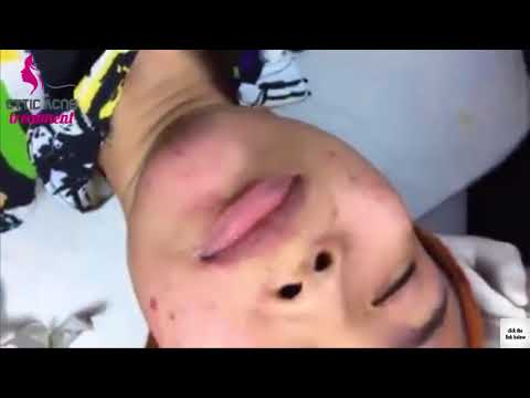 Blackheads and Acne Extraction   Cystic Acne and Zit Removal Facial Treatment At Home