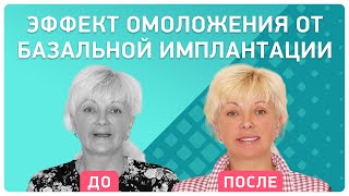 Имплантация зубов за 4 дня. Отзыв пациентки об имплантации зубов в стоматологии Smile-at-Once(, 2017-06-30T08:41:50.000Z)