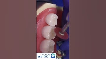 Ultimate Guide to Cusp Build-Up Techniques