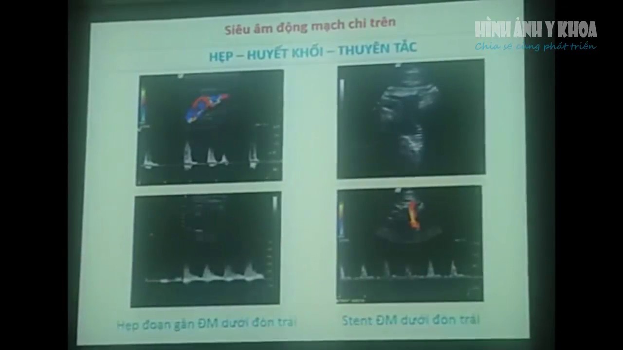 Siêu âm mạch máu chi trên, TS Đỗ Thị Nam Phương