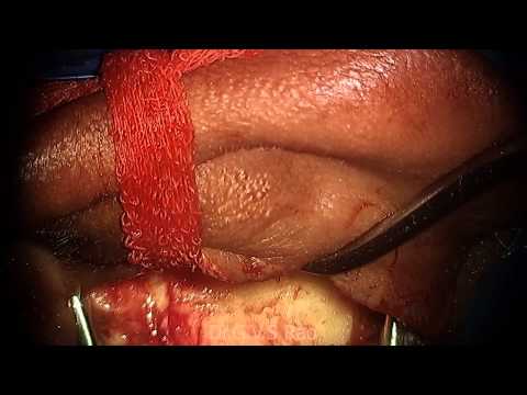 Tympanoplasty FULL HD Part 1