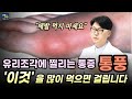왕들의 병.  병들의 왕.  이것을 끊어야 삽니다.  통풍에 걸린 사람들의 특징  통풍 잘 데리고 사는 법.