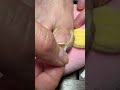 Ingrown Toenail Correction Foot Care Nail Treatment Shorts