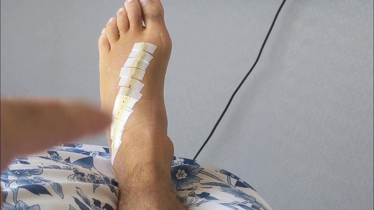 after-ganglion-cyst-surgery-youtube