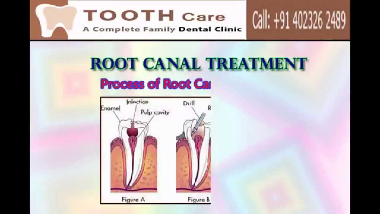 Root Canal Treatment Procedure Video Hyderabad YouTube