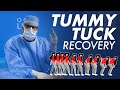 Tummy Tuck Recovery - Standing Up