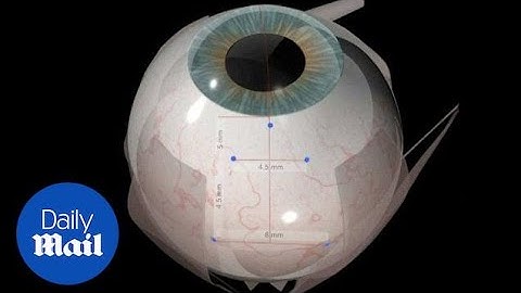 Animation demonstrates how microchip is implanted into the eye - Daily Mail