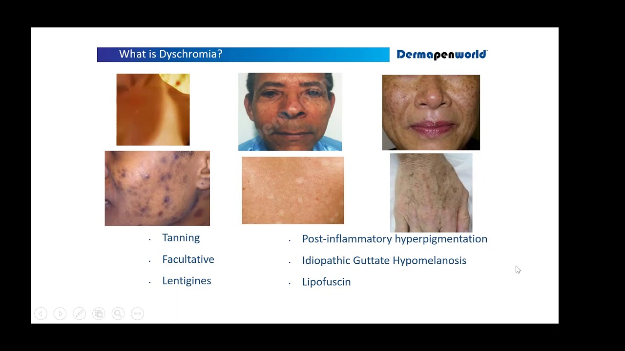 E-Learning - Hyperpigmentation, melasma and dyschromia