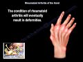 Rheumatoid Arthritis Of The Hand - Everything You Need To Know - Dr. Nabil Ebraheim