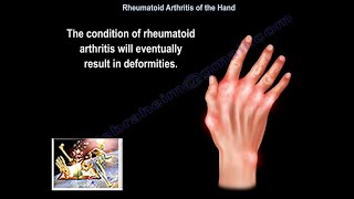 Rheumatoid Arthritis Of The Hand - Everything You Need To Know - Dr. Nabil Ebraheim