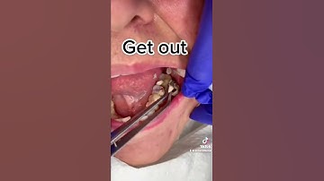 Old crown being kicked out #fyp #viral #video #trending #youtubeshorts #dentist #shorts #tiktok #fyp