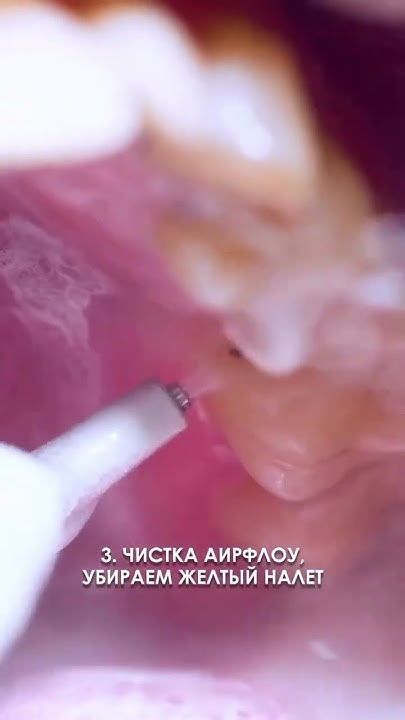 Проф. чистка зубов #стоматология - YouTube