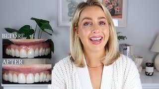 WHAT I'VE HAD DONE TO MY TEETH | COMPOSITE BONDING & WHITENING