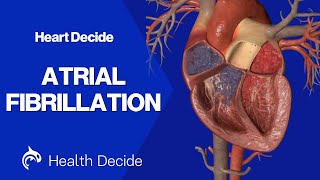 Atrial Fibrillation (AFib) - 3D Animation