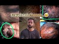 7 recent fraud in hair transplant  worst hair transplant result hairtransplant