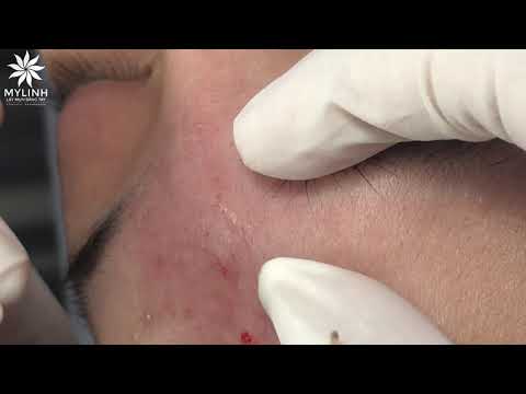 BLACKHEADS AND ACNE REMOVAL # | Lấy mụn ẩn dưới da, mụn đầu đen | 黑頭和粉刺去除 | 