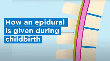 How an epidural is given during childbirth